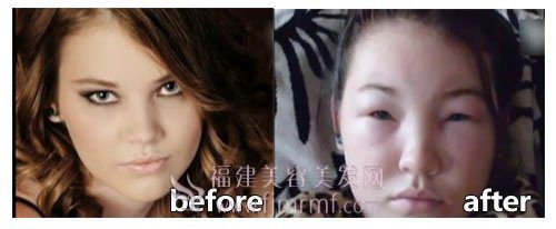 少女染发过敏(mǐn)前(qián)后(hòu)对比(bǐ) 少女染发过(guò)敏前后对比